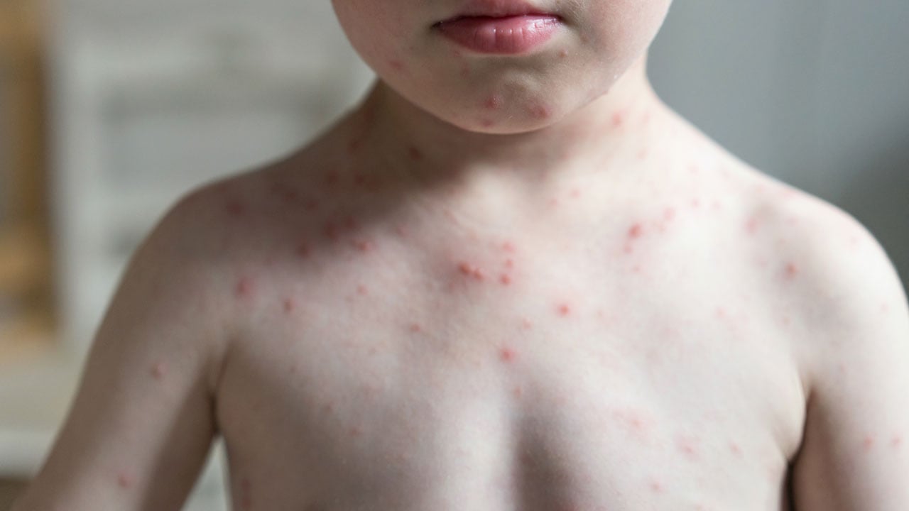 La OMS advierte sobre un aumento ‘alarmante’ en los casos de sarampión