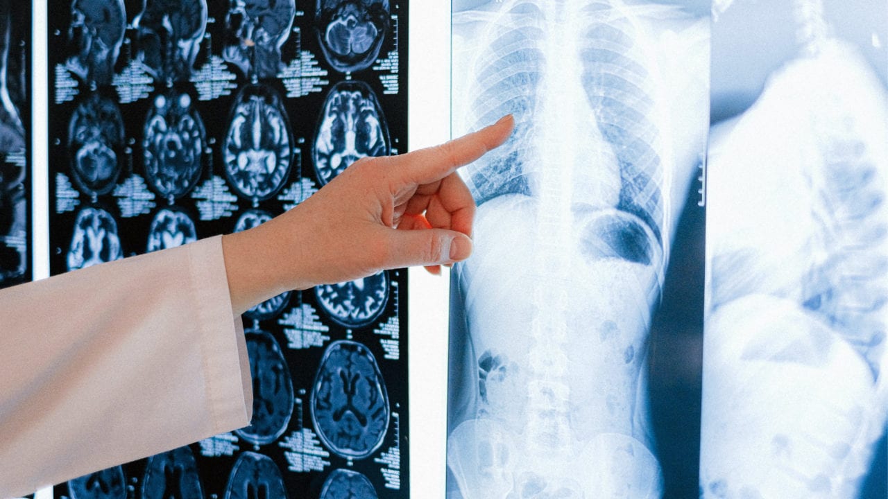 Científicos detectan lesiones de corazón en pacientes graves de Covid-19