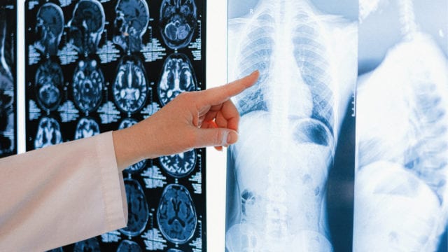 Pulmones radiografía