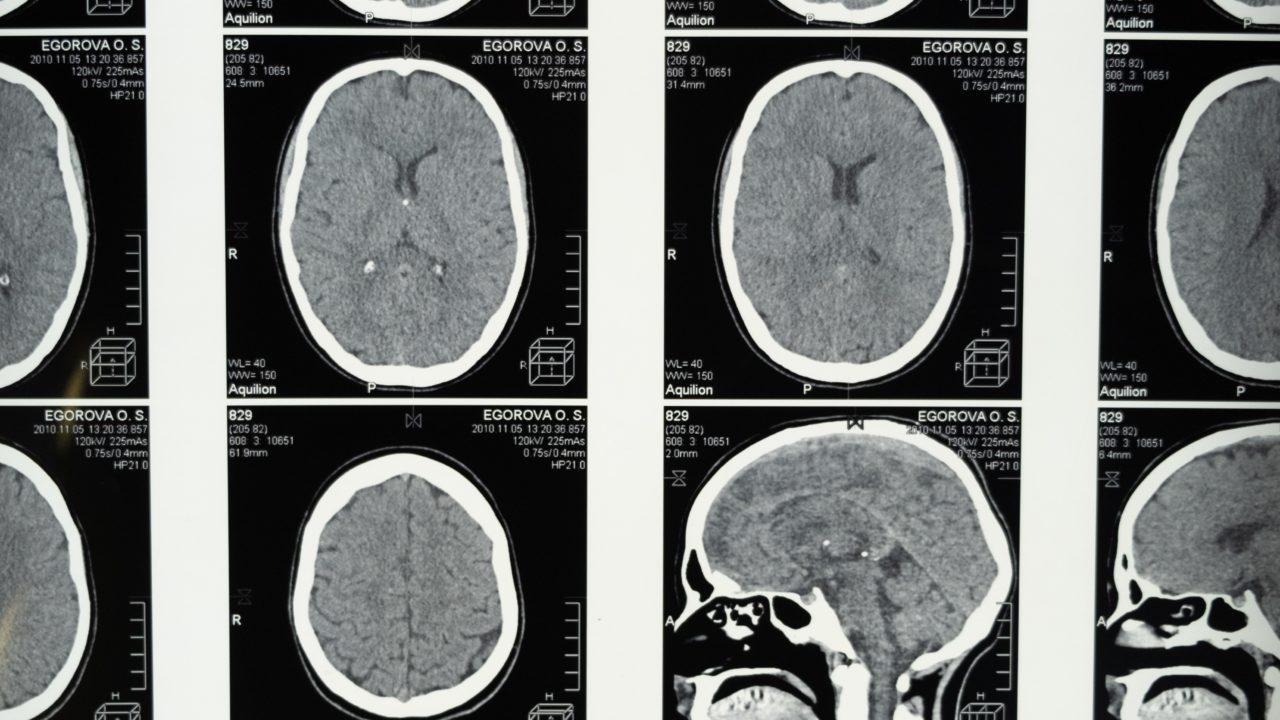 El infarto cerebral es la segunda causa de discapacidad en México