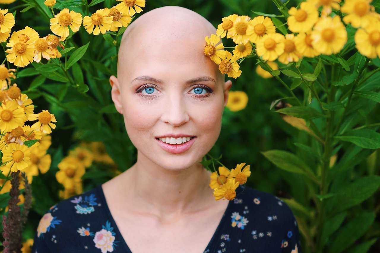 ¿Qué es la alopecia y cuáles son sus principales síntomas?