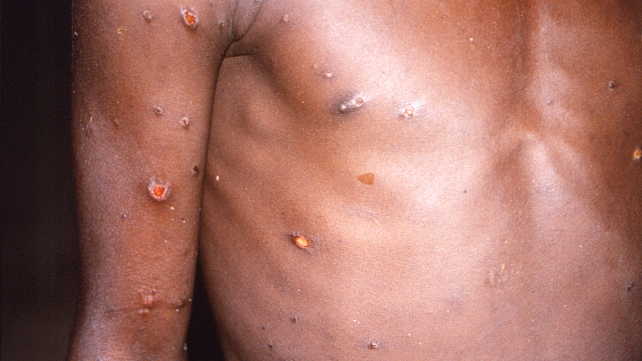 Desnutrición aumenta el riesgo de mpox en niños y embarazadas en el Congo: Save the Children