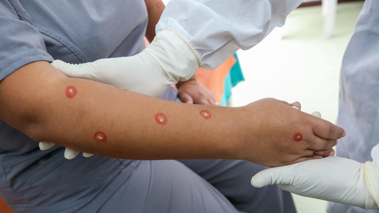 Vacuna contra viruela del mono tarda semanas en inmunizar: OMS