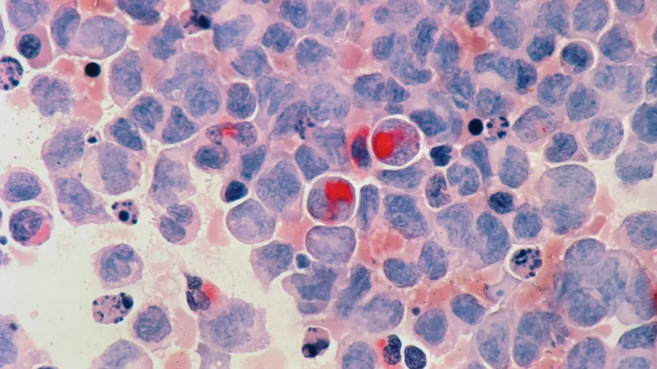 Cánceres hematológicos generan más de 4,000 nuevos diagnósticos por año en México