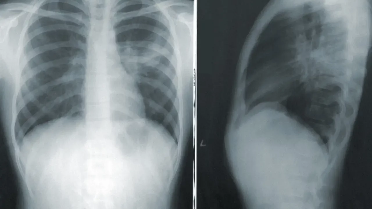El cáncer de pulmón vuelve a ser el más común y letal a nivel mundial