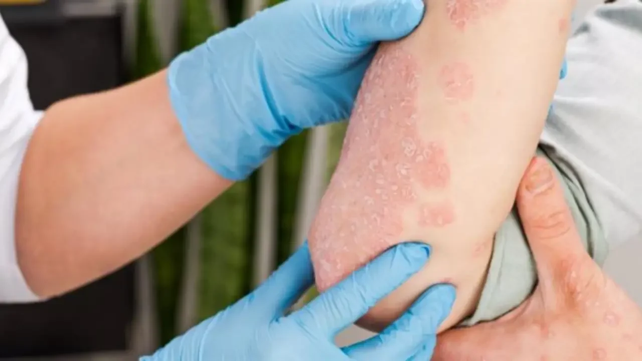 Expertos identifican una mutación genética responsable de la psoriasis