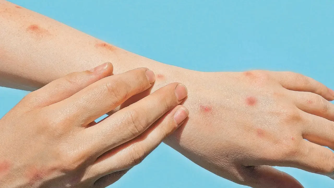 Detectan en Suecia el primer caso de mpox o viruela del mono fuera de África