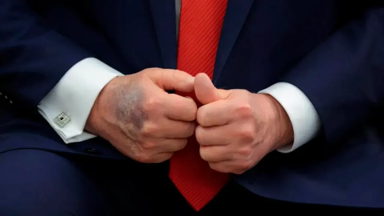 Trump fue visto nuevamente con una contusión en la mano derecha: todo lo que sabemos sobre su condición