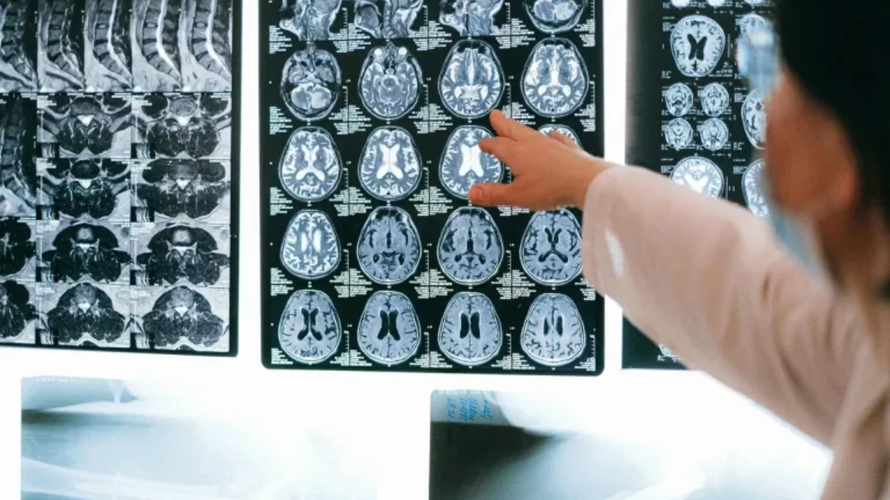 Científicos visualizan por primera vez el desencadenante del párkinson en el cerebro