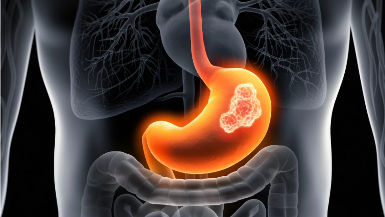 Siete de cada diez mexicanos tienen la bacteria vinculada al cáncer gástrico