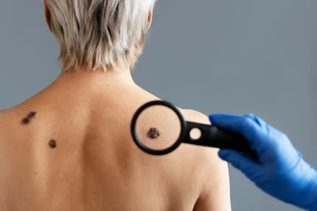 Científicos mexicanos investigan el desarrollo del cáncer de piel más común en el país